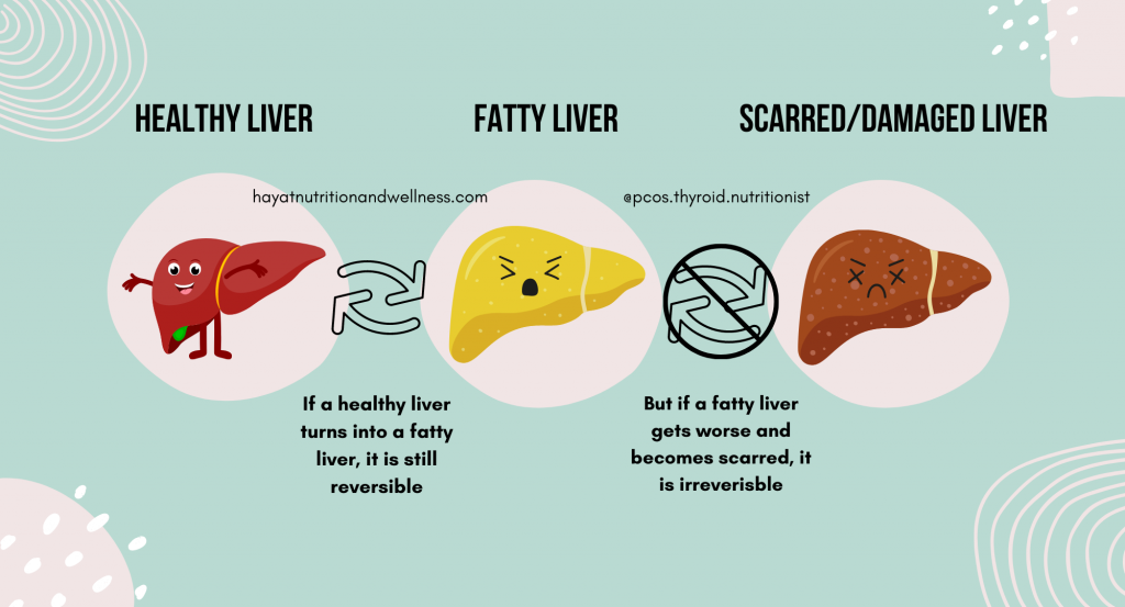Picture shows 3 livers, 1 healthy, 1 fatty, and 1 damaged. There are cyclical arrows between the healthy and fatty with text below "if a healthy liver turns into a fatty liver, it is still reverisble". There are cyclical arrows between the fatty liver and the scarred/damaged liver with with a stop sign, text below says "But if a fatty liver gets worse and becomes scarred, it is irreversible"